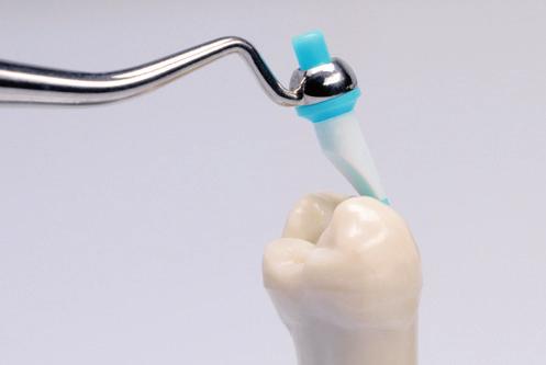 Correctly designed proximal marginal ridges facilitate effective cleaning of interdental spaces;