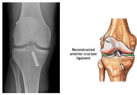 GG10Rehabilitation Programme for Arthroscopically Assisted Anterior Cruciate Ligament Reconstruction Femur ACL Graft Fibula Tibia The Anterior Cruciate Ligament (ACL) is one of the main ligaments in