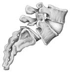 facets or both with gradual slipping of the L5 vertebra Type II A Type II A is