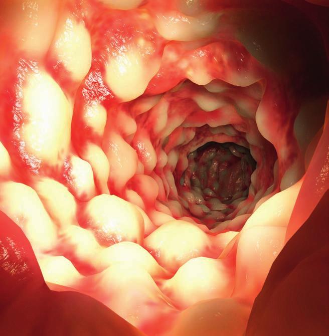 n DRUG REVIEW Current management options and recent advances in IBD Ben Warner BSc, MRCP and Peter Irving MA, MD, FRCP SPL The advent of biological therapies has revolutionised the management of