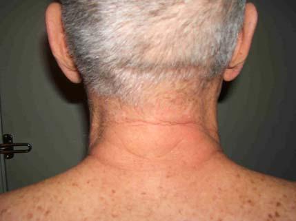 The images top left have arrows showing the location of inflammation on the right side of his neck.