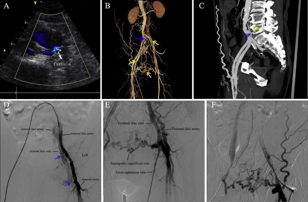 4 H. Yuan et al. Figure 1. (A) Pre-operative ultrasound examination: arteriovenous fistulae (AVFs) between left external iliac artery and vein.