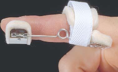 BUNNELL SAFETY PIN SPLINT Reduces flexion contractures. (Sizing: Measure finger from proximal finger crease to middle of nail bed).