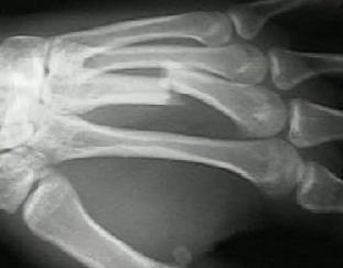 Hand injuries Metacarpal injuries The metacarpal bones may fracture through the