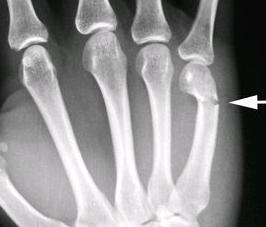 Transverse # spiral # slab K-wire Neck #; usually that of the 5 th metacarpal,