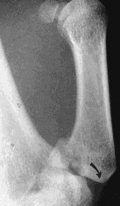 X-ray: a triangular fragment remains with trapezium while the thumb subluxate proximally by