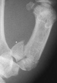 reduction & mini-screw fixation, in severely comminuted # ligamentotaxis using external