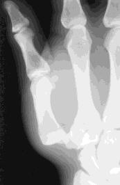 Mallet finger mechanism of