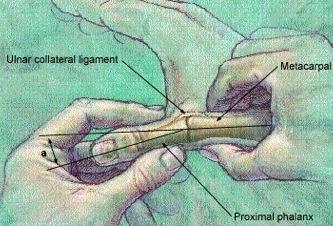leads to partial or complete tear, this require 10 days splint; if bone fragment avulsed, it may