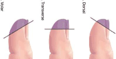 Finger tip injuries: These usually result from a cut wound, the treatment depends on the age & whether the bone exposed or not.