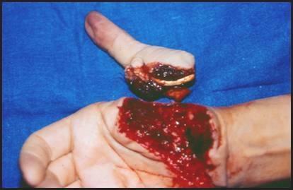 Replantation Amputated thumb or digit can be replanted & this requires microsurgery in special