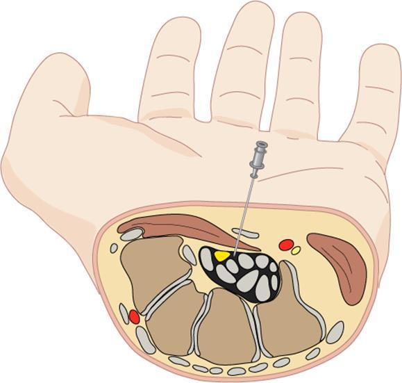 Injection Technique Insert needle just ulnar to the palmaris longus tendon and at the proximal wrist crease The needle is inserted at a 30- degree angle and directed toward the ring finger.