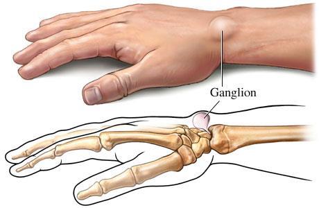 Etiology Arises from joint capsule or tendon sheath