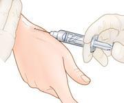 Injection Technique Keep thumb abducted and extended, palpate the course of the tendons distal to the radial styloid.