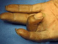 Exam She has a palpable nodule on the palmar surface of the hand at the level of the A1