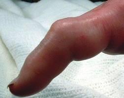 Exam Semi-flexed position of finger Fusiform swelling Excessive tenderness
