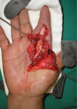 Etiology and Treatment Infection of the tendon sheath Can extend proximally via sheath/bursa Can