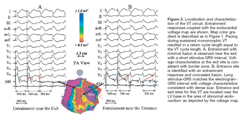 Characterization of Endocardial Electrophysiological Substrate in Patients With