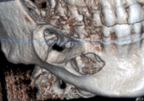 222 A Textbook of Advanced Oral and Maxillofacial Surgery Figure 10. reconstruction of the same lesion in figure 9.