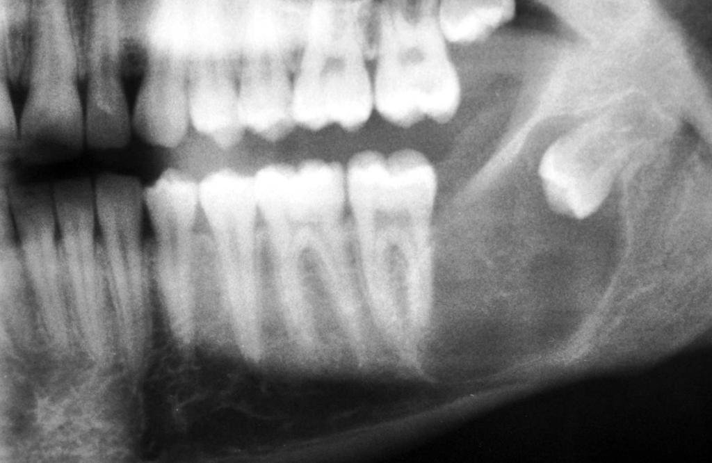 lso, in 25 to 40% of cases, an impacted tooth is present within the KCOT lumen [7], and such lesions should be distinguished from dentigerous cysts.