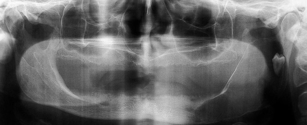 Keratocystic Odontogenic Tumors Clinical and Molecular Features http://dx.doi.org/10.5772/53855 223 Figure 12. Panoramic radiograph of a KCOT involving left mandibular angle and ramus.