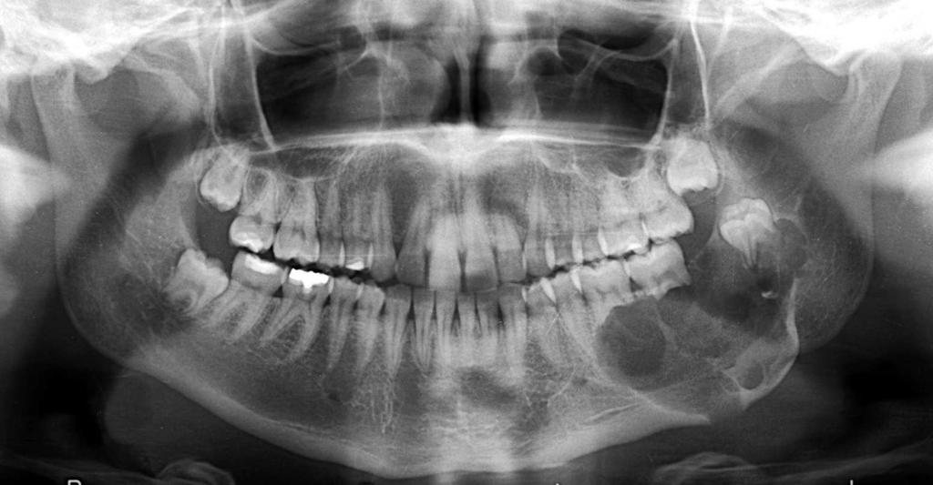Regarding radiographic differential diagnosis, in most of the cases KCOTs should be distinguished from dentigerous cysts and ameloblastomas (Figure 15). Figure 15.