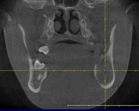 228 A Textbook of Advanced Oral and Maxillofacial Surgery series of 31 mandibular KCOTs, marginal resection of affected jaw in conjunction with soft tissue excision resulted in complete elimination