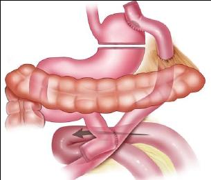 Hernia After Gastric