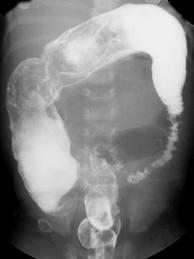 malformation defined as the absence of ganglion cells in the myenteric and submucosal plexuses of the terminal rectum +/- more proximal bowel Functionally marked by intestinal obstruction caused by