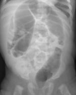 Enterocolitis Signs and Symptoms: Fever Abdominal distention Not stooling Vomiting Explosive diarrhea