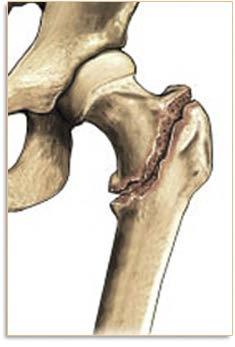 Your surgery You have had surgery in which metalwork has been put into to the top of your thigh bone (neck of femur) to fix the break, as shown in the diagram. Pain control All fractures are painful.