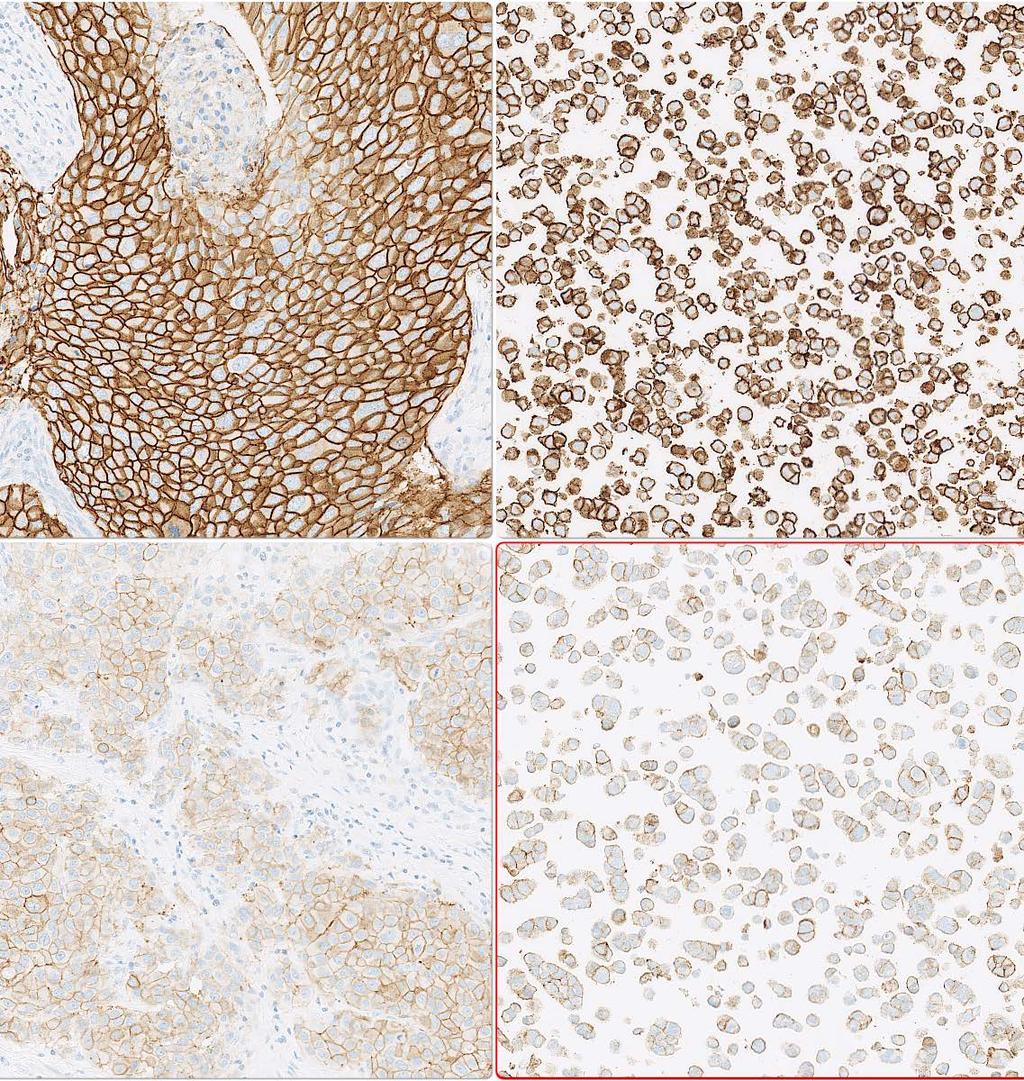 HER2 IHC: Controls Histology: 3+ tumour 2+ tumour Cell