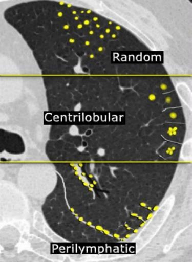 Random Randomly distributed relative to the structures of the lung and secondary lobule Centrilobular Nodules spare the pleural surfaces Most peripheral nodules are centered 5-10 mm