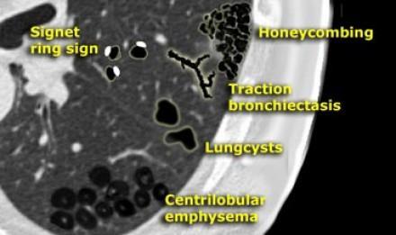 Emphysema Areas of low attenuation without visible walls as a result of parenchymal destruction Honeycombing Presence of small cystic spaces with irregularly thickened walls