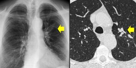 Bronchiectasis Localized bronchial dilation Bronchial wall thickening, lack of normal tapering with visibility of airways in the peripheral lung, mucous retention in the bronchial lumen Prior