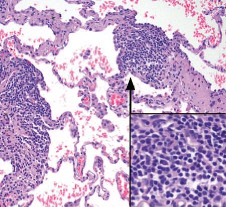 Histologic Features Diffuse infiltration of the interstitium by lymphocytes, plasma cells, and histiocytes Reactive lymphoid follicles distributed along the peribronchiolar regions Imaging Features