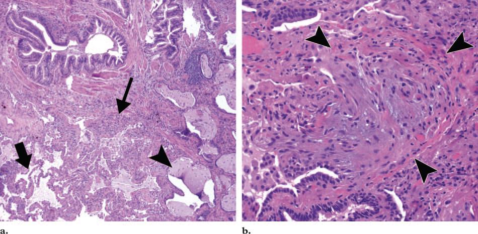 Histologic Features Hallmark of usual interstitial pneumonia (UIP) is presence of scattered fibroblastic foci Lung involvement is heterogenous and areas of normal lung