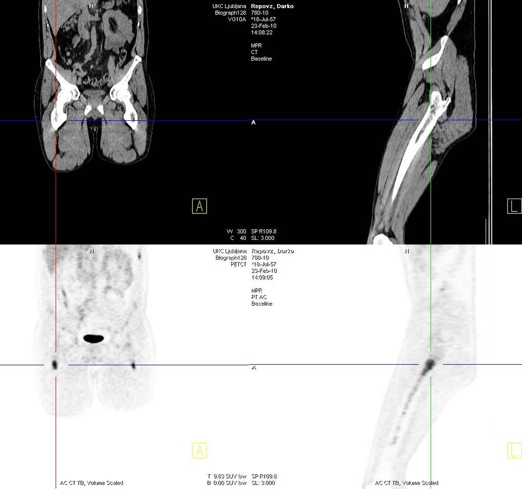 PET-CT preiskava z 18 F-FDG