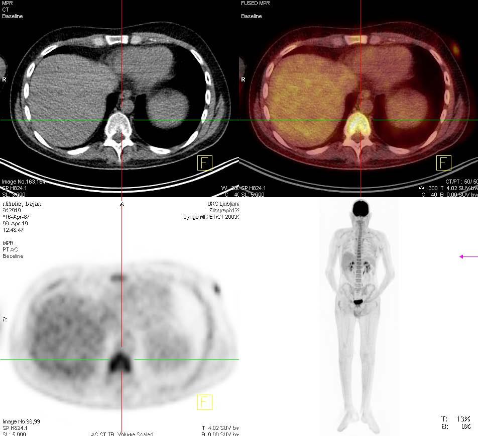 PET-CT preiskava z 18 F-FDG v