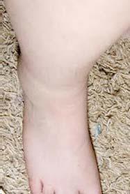 increased lower extremity edema since