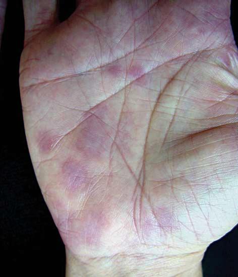 Figure 3. Patient 1: tender, erythematous annular plaques on the palm.