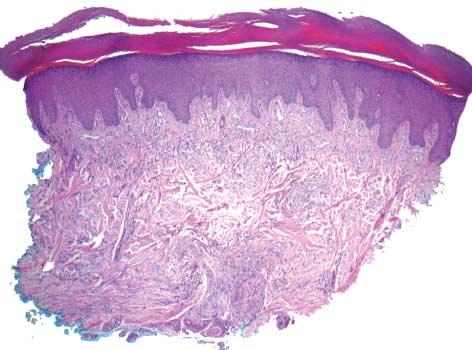 Figure 6. Patient 1: a palisading granuloma with incomplete collagenolysis fills the reticular dermis in this fragment of acral skin (hematoxylin-eosin, original magnification 40). opsy specimens.