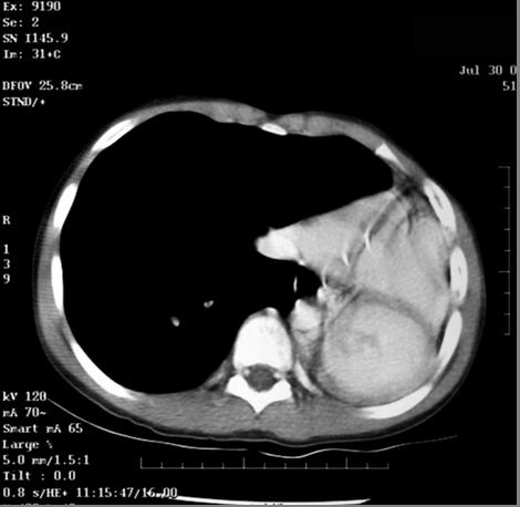 Post-Op Chest CT: Mediastinal Window S/PL pneumonectomy Shift of