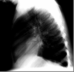 hemi-diaphragm Likely anterior lingular mass +/- Calcifications at left lung