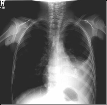 Chest X-rays Showing Acute Pneumonia PA View Lateral