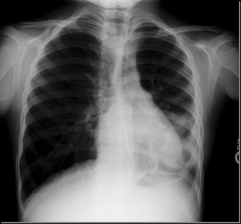 Follow-up Chest X-rays PA View Lateral View Chest X-rays demonstrating resolving