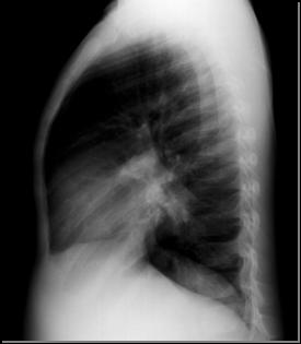 Several amorphic calcific densities in left lower lung.