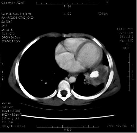 Our Patient: Chest CT, 1999 Film Findings: Calcified mass in left lingula LLL collapse/ consolidation No evidence of mediastinal lymphadenopathy No liver or splenic