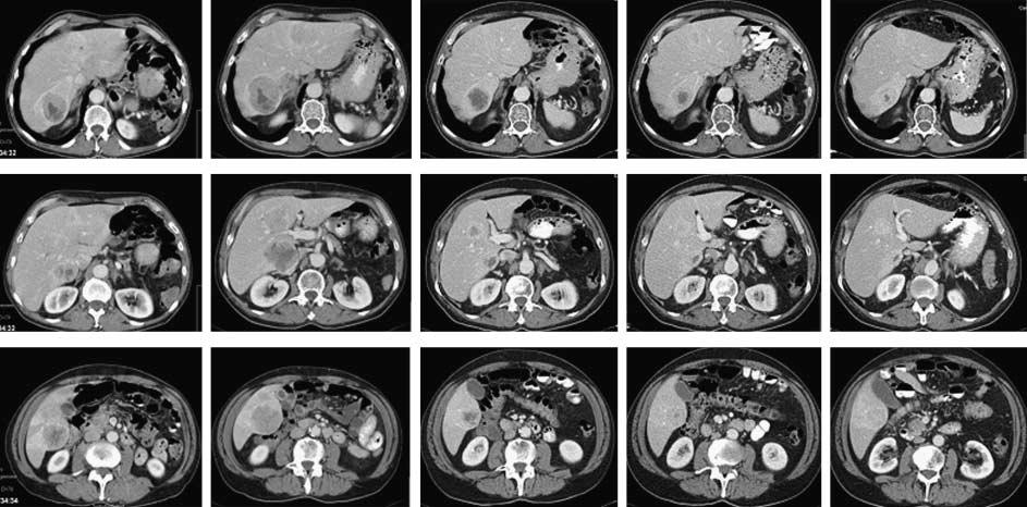 D J Kwekkeboom et al.: SRI and PRRT in GEPNETs A B C D E Figure 6 Serial CT scans with identical tumor sites in the liver in a patient with metastatic pancreatic neuroendocrine tumor.