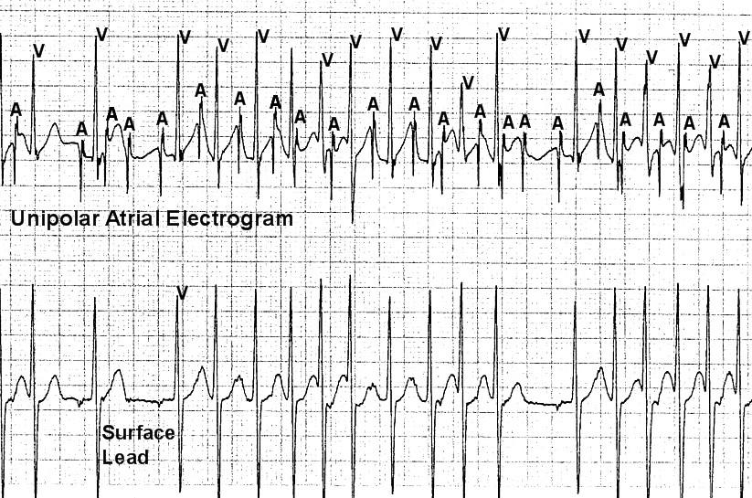 This is atrial flutter with 2:1 ventricular conduction. Figure 1. The surface electrocardiogram (lower tracing) reveals an irregular, narrow complex rhythm.
